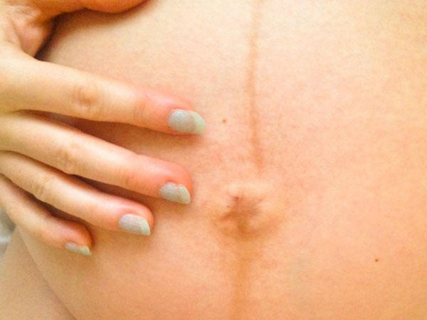 vạch nâu ở bụng có phải có thai không